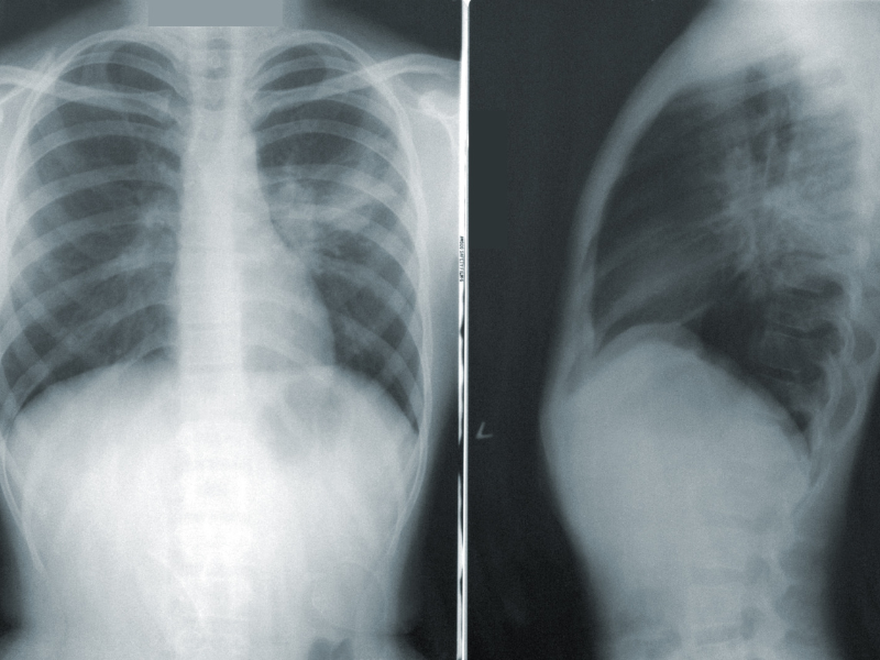 You are currently viewing Extensive-Stage Small-Cell Lung Cancer: Hope Is on the Horizon